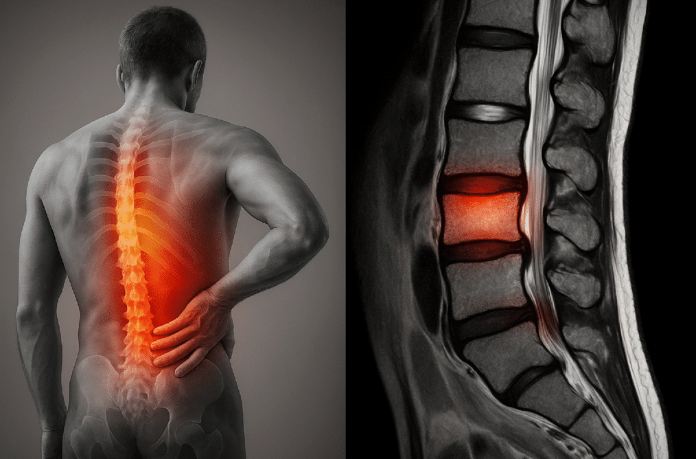 ¿Cómo se diagnostica el dolor discal lumbar? : síntomas, diagnóstico y tratamiento