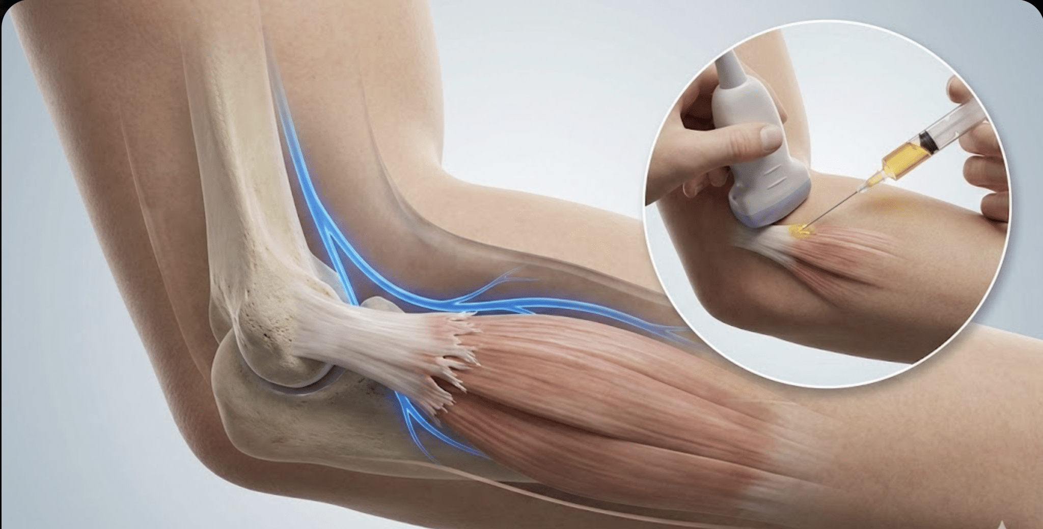 Dolor lateral de codo (codo de tenista): diagnóstico diferencial y tratamiento con PRP ecoguiado (2026)