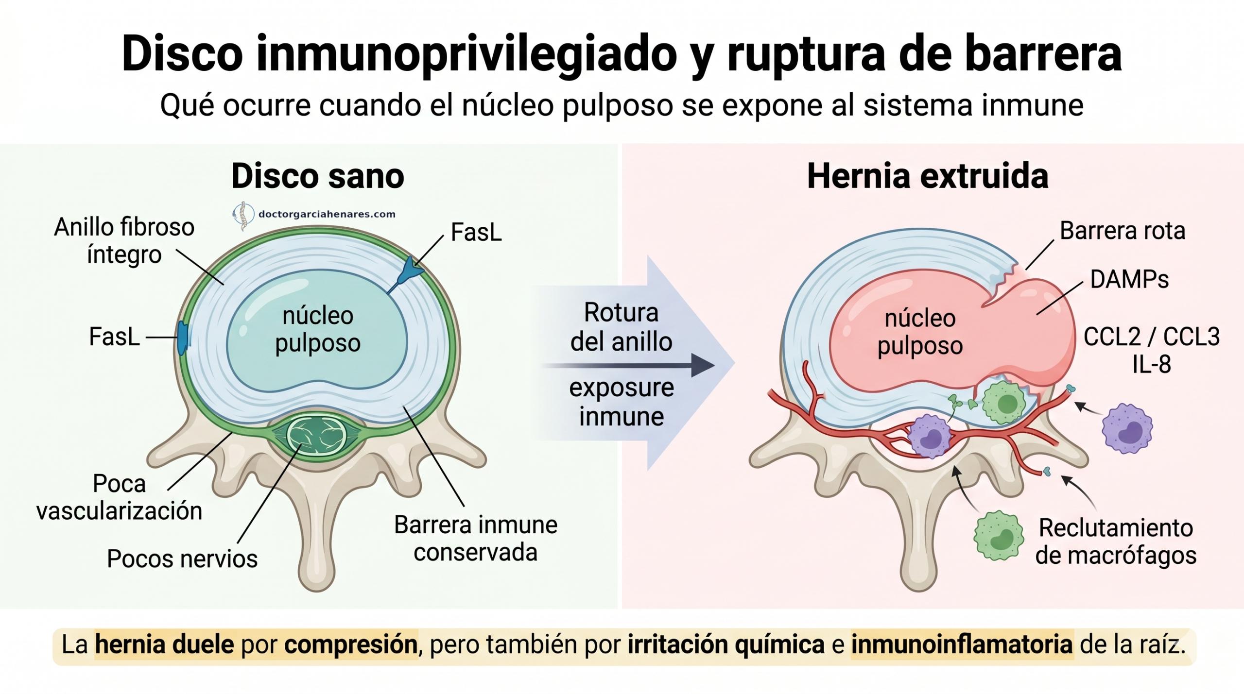 Ozonoterapia para hernia discal lumbar