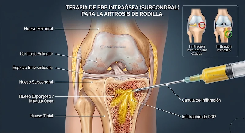 Tratamiento del PRP intraóseo